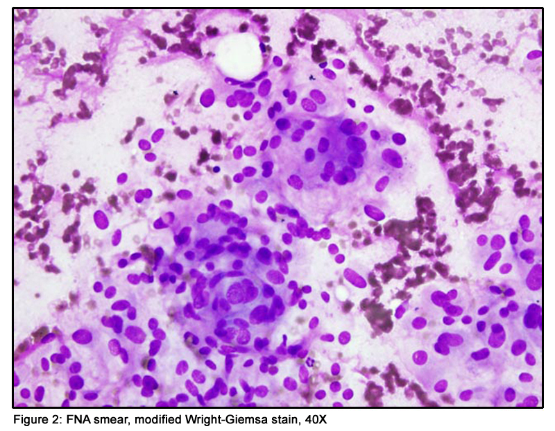 ARUP Laboratories Resource for Education: Case Report: Fine Needle ...