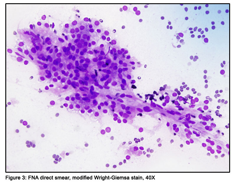 ARUP Scientific Resource for Research and Education: Case Report: FNA ...